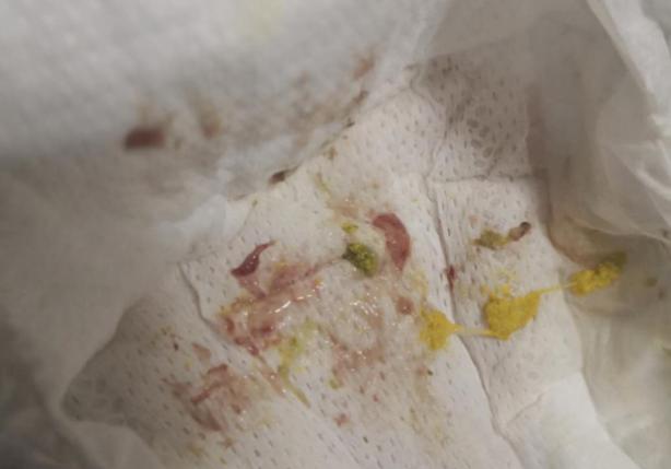 宝宝大便带血分析,宝宝细菌性腹泻大便带血