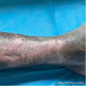 (南通发布)多科协作显神效,八旬老汉的老烂腿终于治愈了