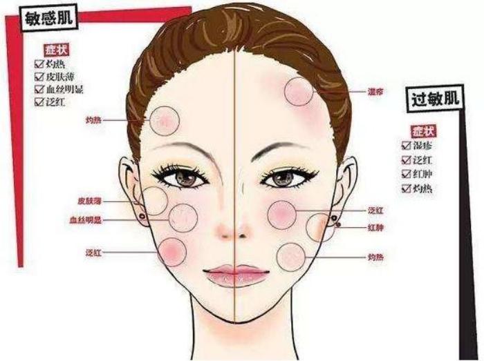 脸上有瑕疵是红血丝吗,怎么判断脸上有红血丝