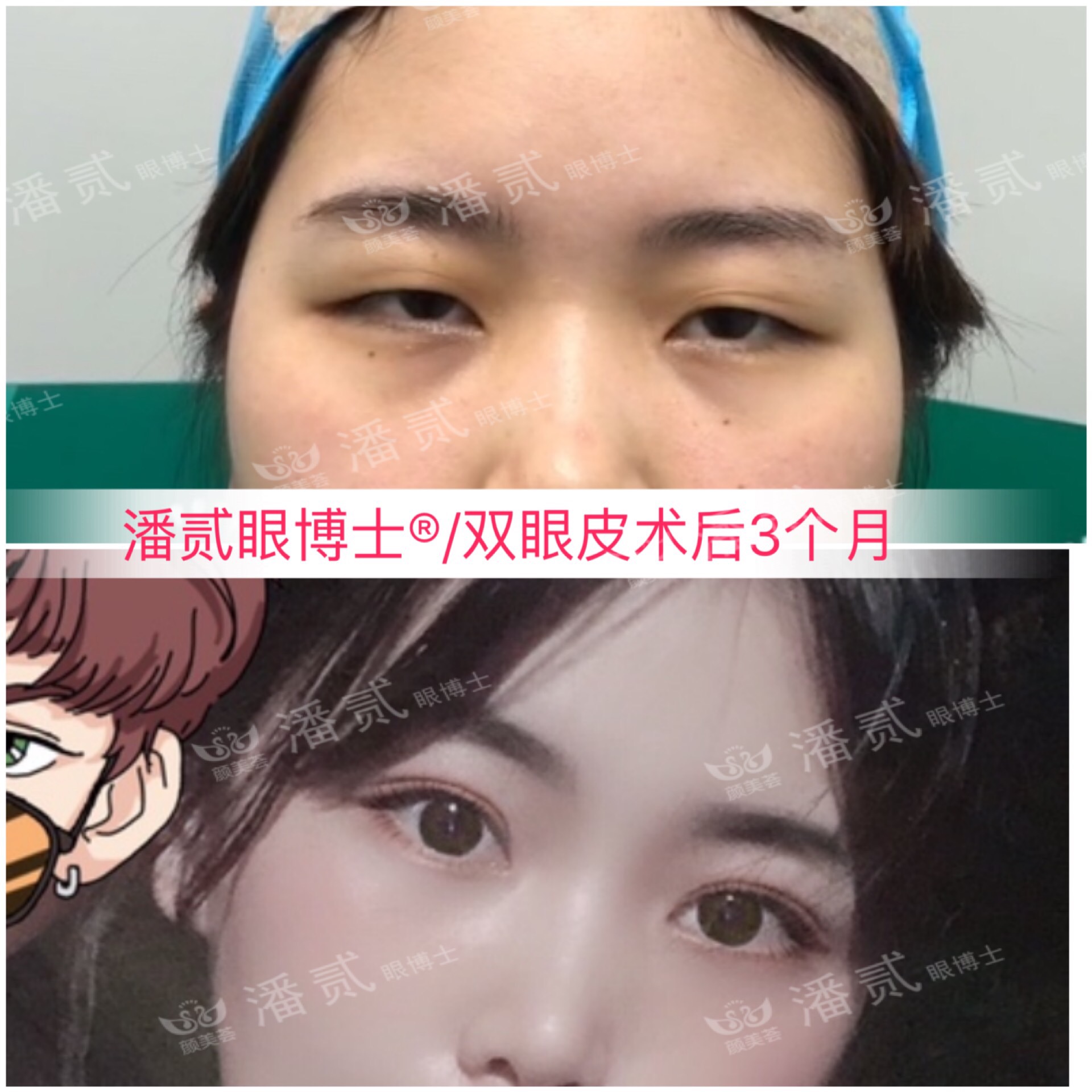 双眼皮眼尾割长了而且上扬怎么办,眼睛眼尾下垂做什么样双眼皮