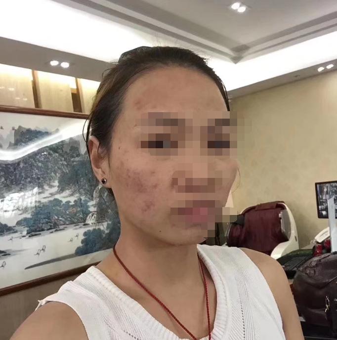 30岁了还长青春痘用什么药,30多了怎么还长青春痘