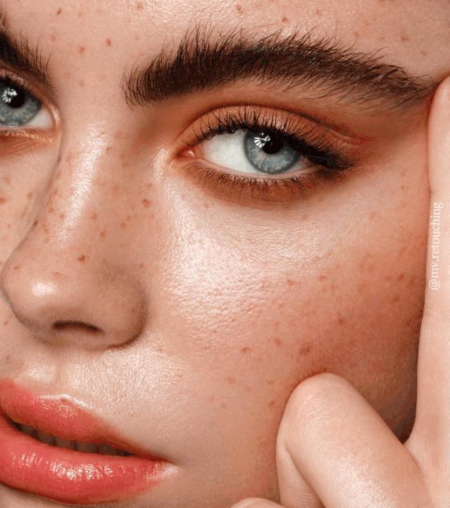 祛斑要注意哪些事项,祛斑为什么会越祛越多