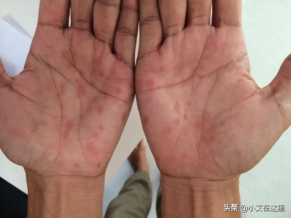 怕感染性病？这些知识，有无*生活性**都该知道