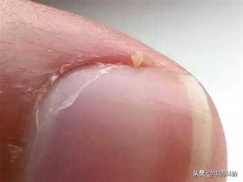指甲上没月牙有横线长倒刺,关于指甲的科普指甲上的疾病视频