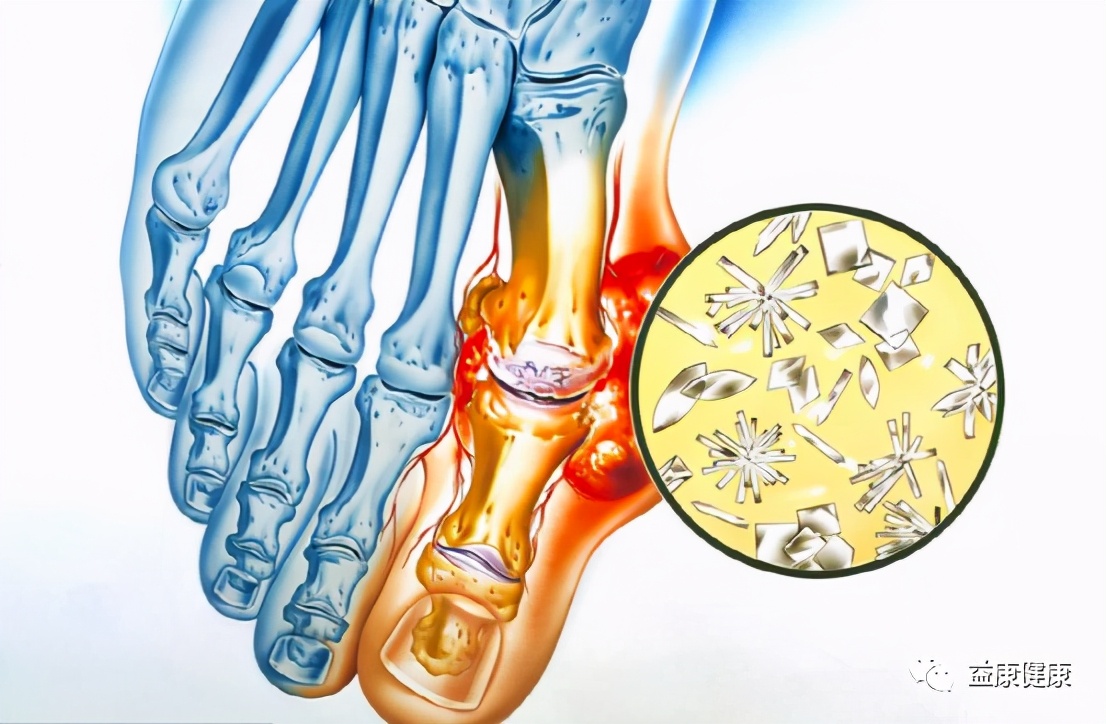 尿酸高看尿素吗,尿酸高你知道的8个真相