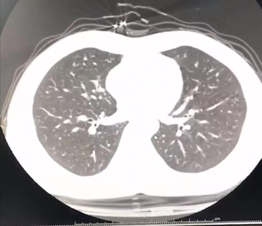 新冠感染居家隔离该怎么用药,新冠病毒居家隔离治疗