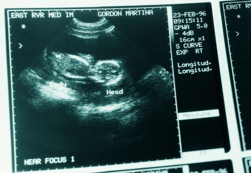 强行保胎胎儿畸形,8个月孕妇产检畸形