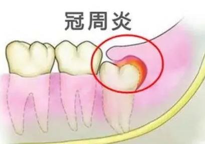 牙齿反复发炎,吃药也没用!该怎么治疗才好?