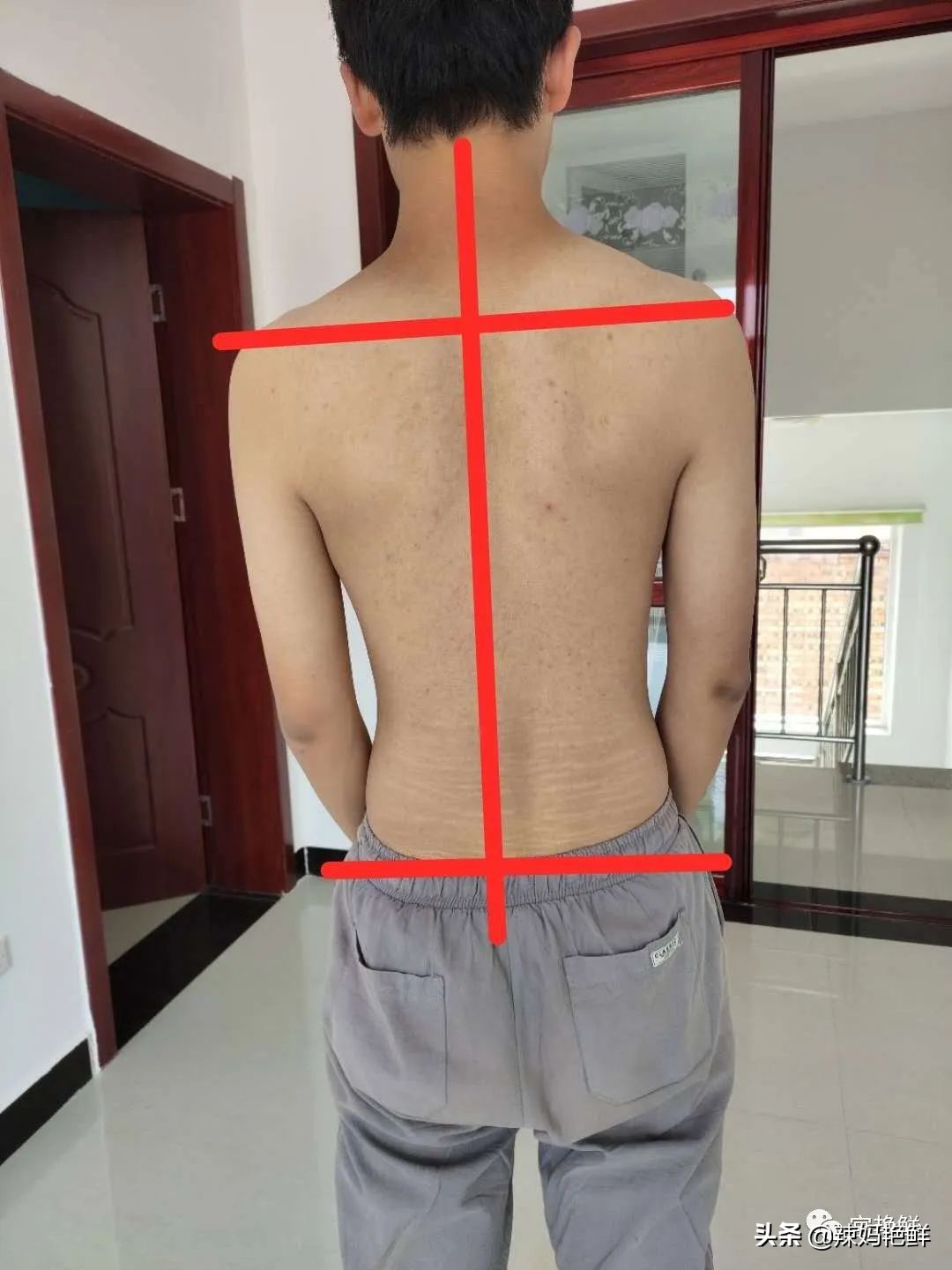 看起来驼背的几种情况,驼背后背中间驼怎么矫正