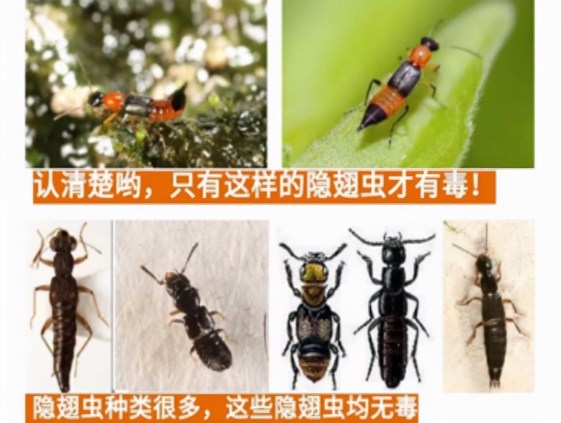 被隐翅虫咬伤有多可怕,被隐翅虫咬后症状图片及治疗方法