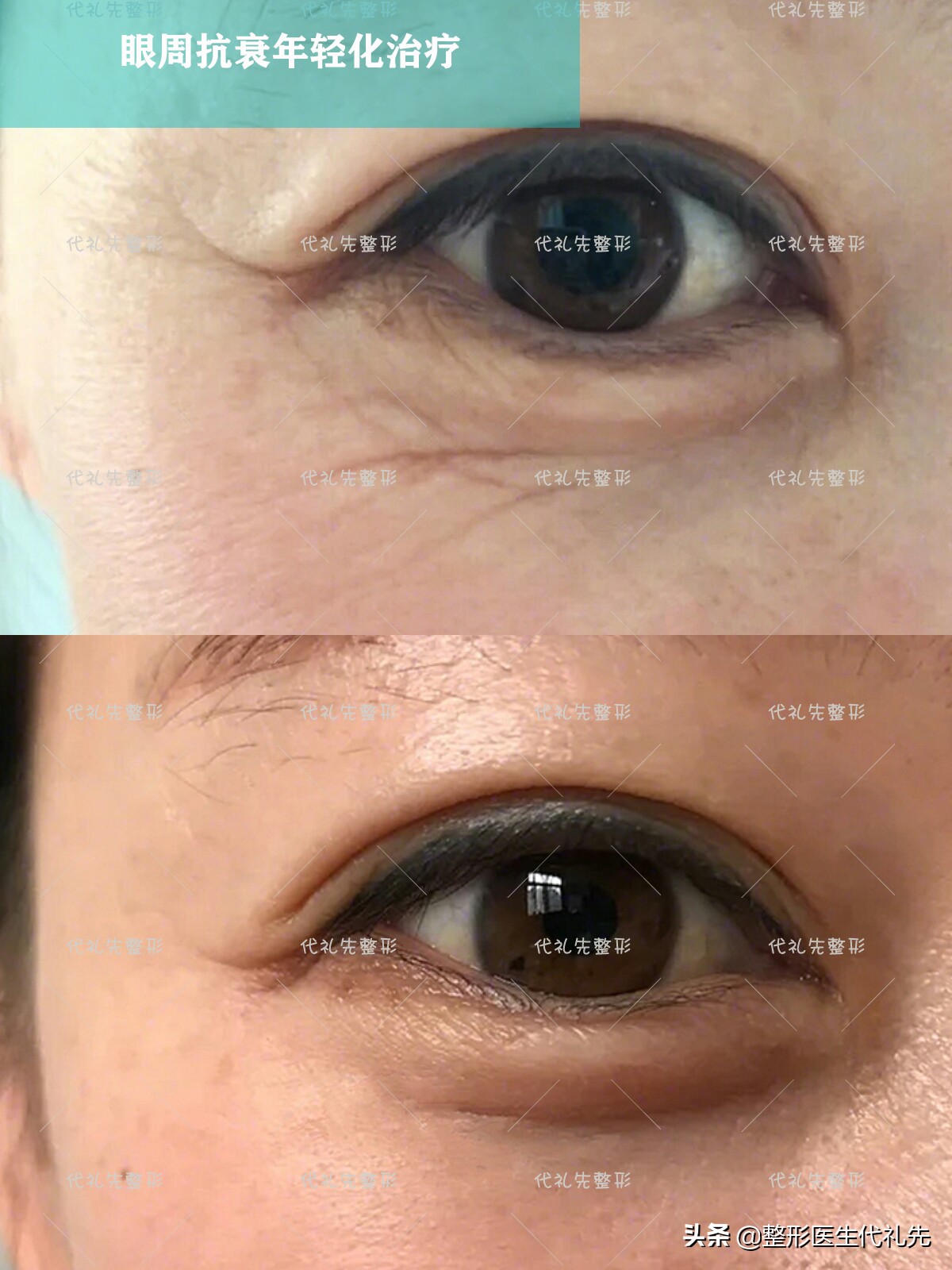 眼细纹和眼纹,眼部衰老导致眼纹