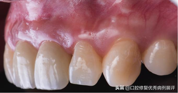 展评优秀病例赏析|Asc全瓷角度基台一体冠进行种植前牙美学修复