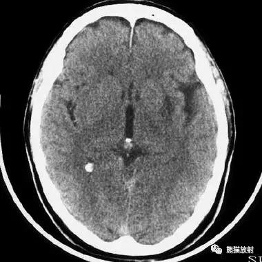 各部位脑梗死ct影像讲解,脑梗死ct影像最简单的是什么表现