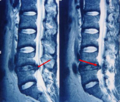 腰椎滑脱和腰椎间盘突出哪个严重,想知道腰椎间盘突出是怎样引起的