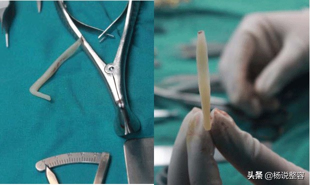 隆鼻失败修复的几点建议,隆鼻失败医生会马上为患者修复吗