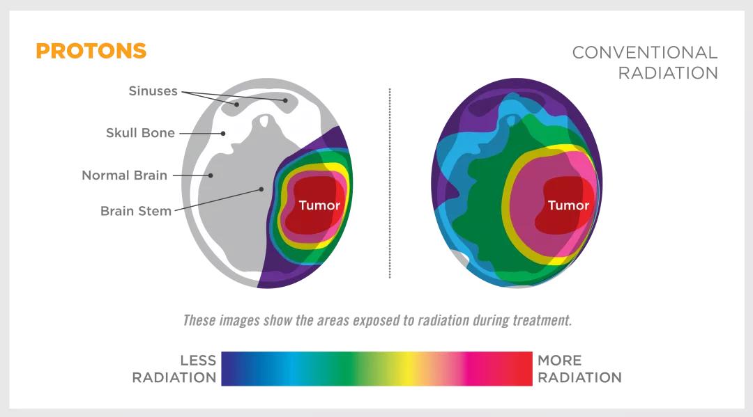 质子放疗治疗后的副作用,质子放疗对人体的损伤