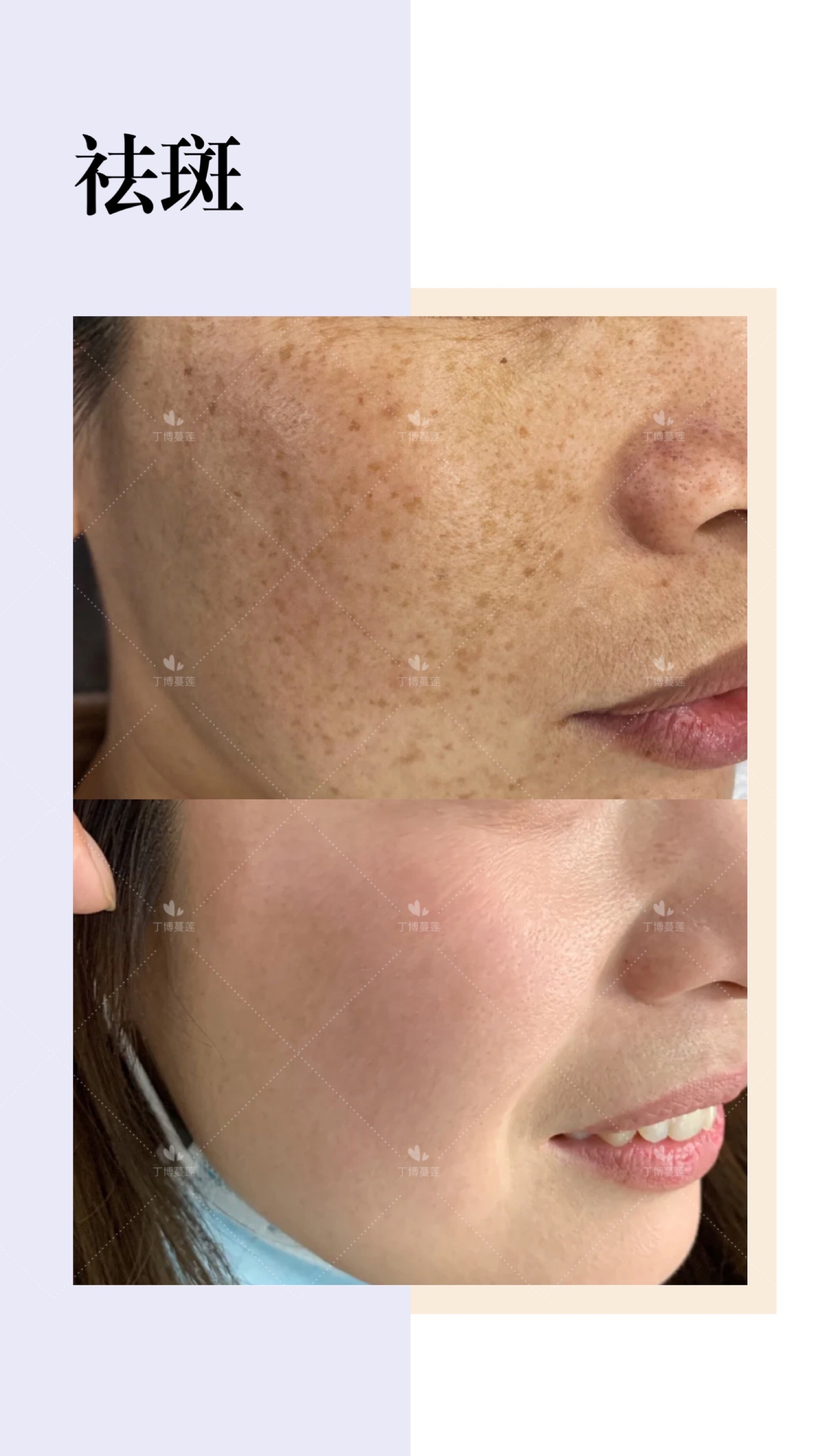 雀斑激光祛斑需要几次才能祛干净,有什么办法可以祛雀斑不反弹