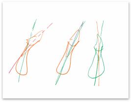 骨性龅牙和牙性龅牙的区别,牙性龅牙和骨性龅牙怎么矫正