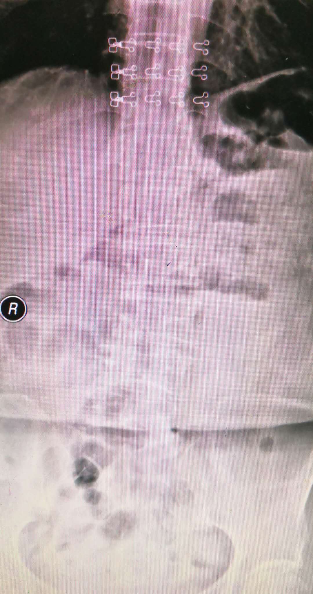 腰椎滑脱做开放手术需要多少费用,腰椎滑脱微创和开放手术哪个好