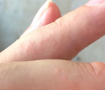 夏天手上长痘痒是怎么回事,夏天手上起小水泡发痒怎么回事