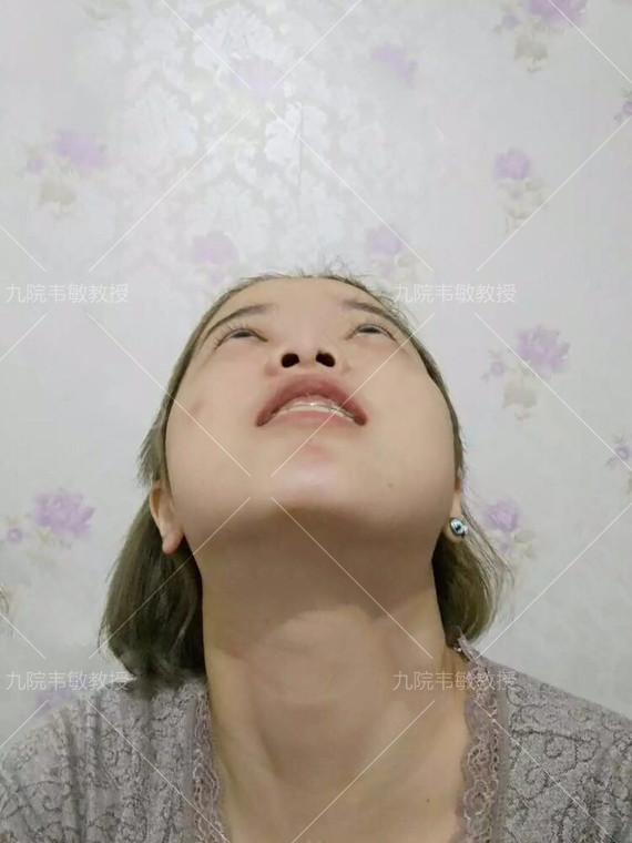 假体隆鼻科普之膨体隆鼻,膨体隆鼻整形效果怎么样