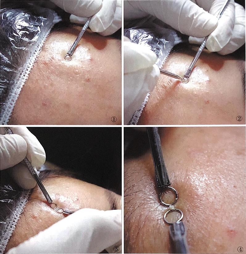 痘痘可以挤吗正确处理方法告诉你,哪种痘痘能挤哪种痘痘不能挤