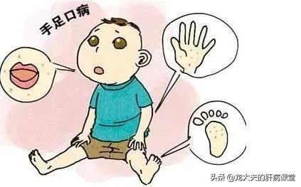 成年人得手足口病的最佳治疗方法,手足口病的注意事项以及治疗方法