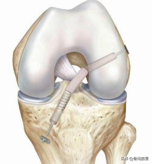 微创术后直抬腿的正确训练方法,术后如何直抬腿