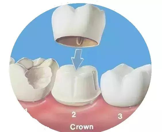 全瓷牙与烤瓷牙价格差多少,全瓷牙和烤瓷牙的价格差多少