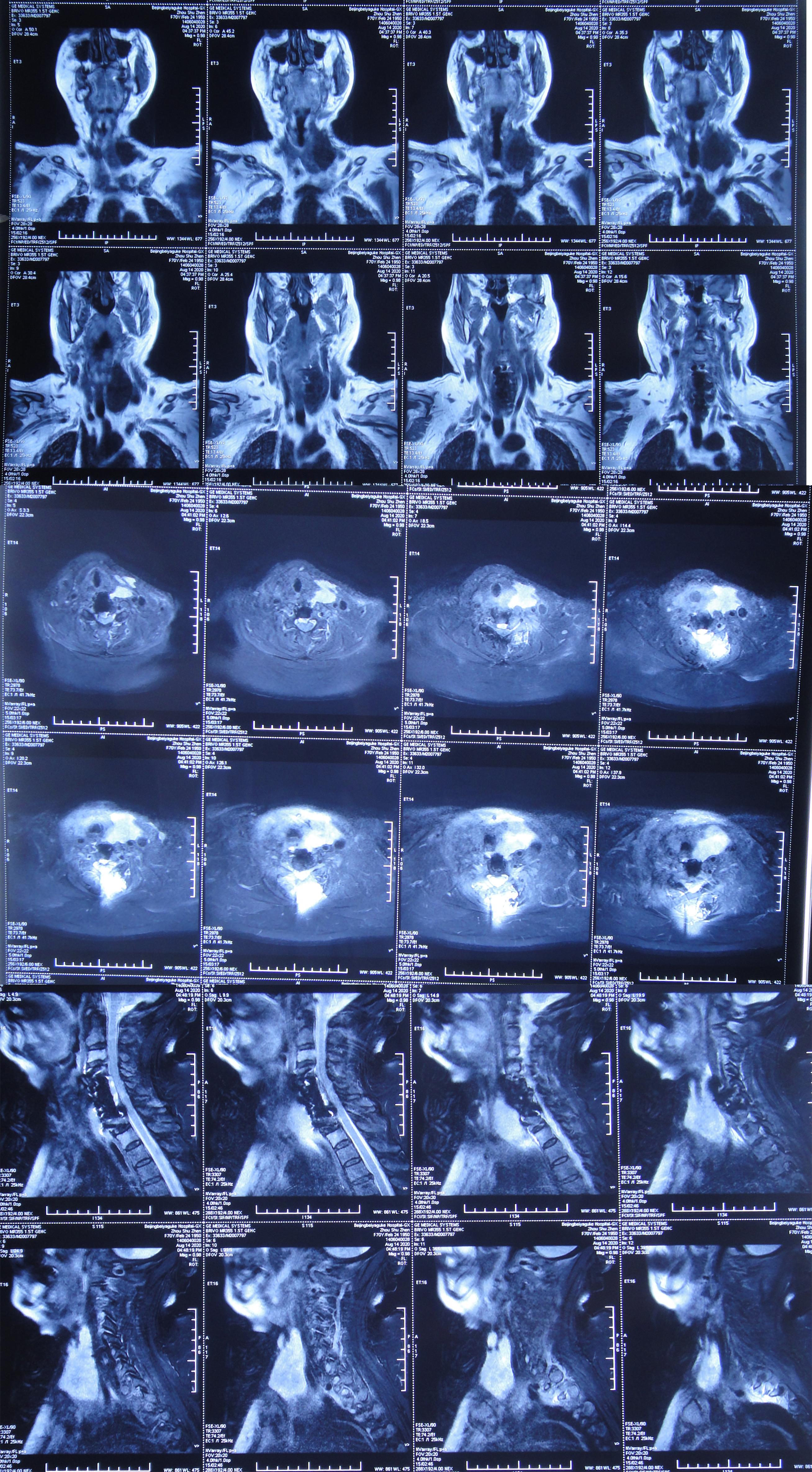颈椎术后脑脊液漏取什么体位,脊髓型颈椎病手术后植骨愈合时间