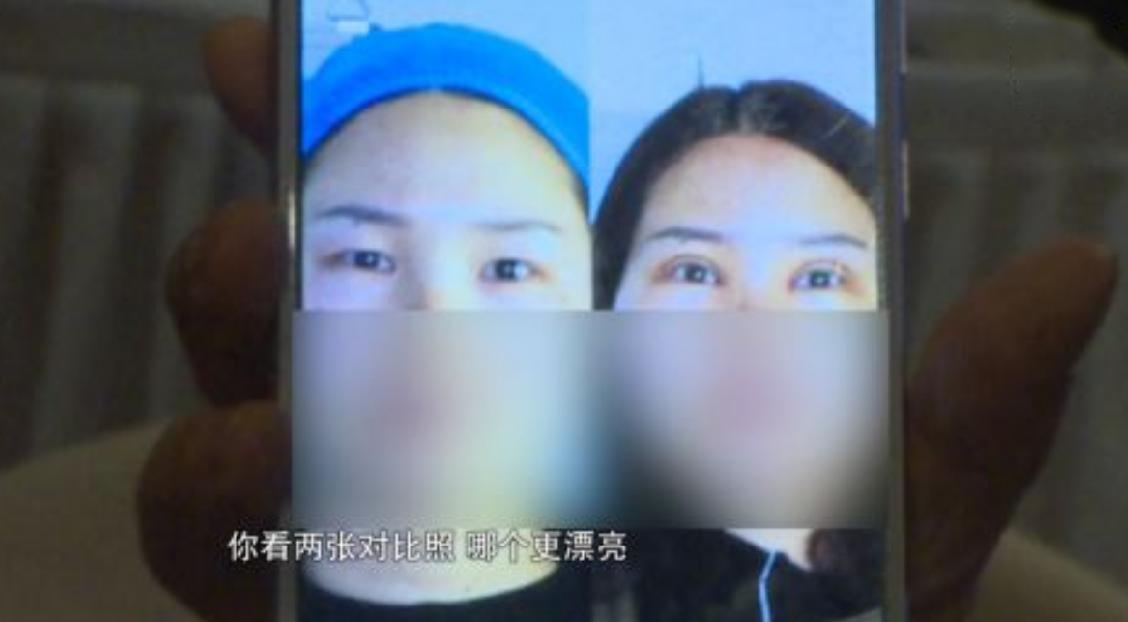 女子在家里自己做双眼皮手术,妻子经常在半夜梦里哭