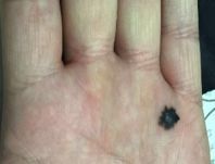 黑色素痣癌变的前兆切除能治愈吗,激光点黑色素痣能诱发恶变吗