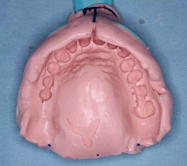 咬合重建详细步骤,如何制作咬合模型