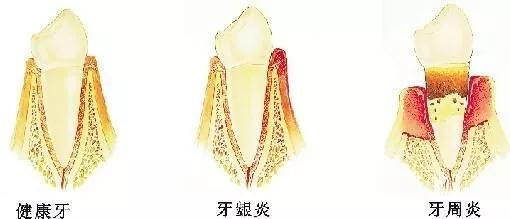 牙齿上火牙龈痛怎么止痛,牙龈肿是牙齿坏了还是上火引起的