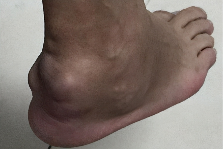 脚背痛风与大拇指痛风,痛风都什么症状关节会肿吗