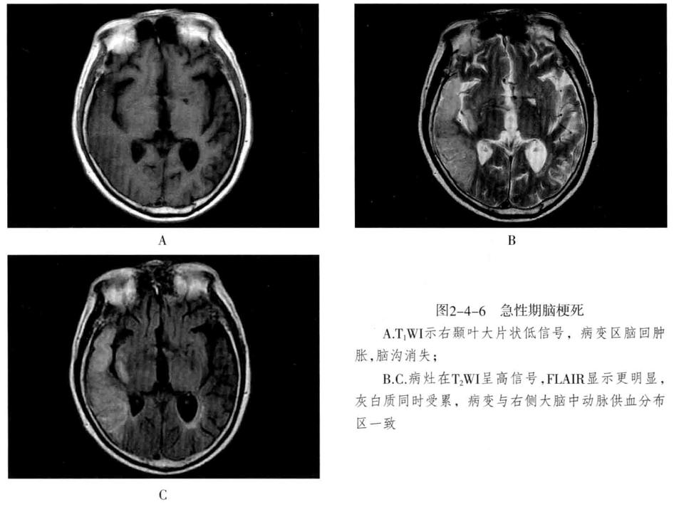 颅内血管轻度狭窄诊断标准,颅内血管先天变异影像