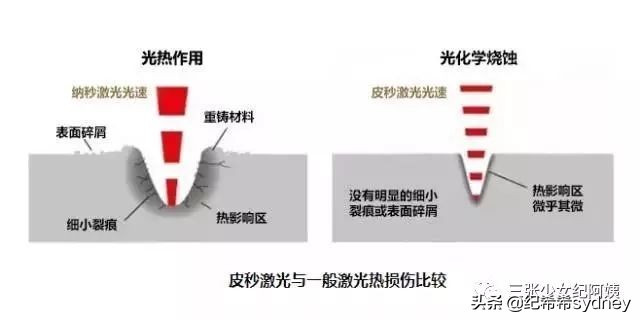 热玛吉超声刀光子嫩肤,超声炮热玛吉光子嫩肤的区别