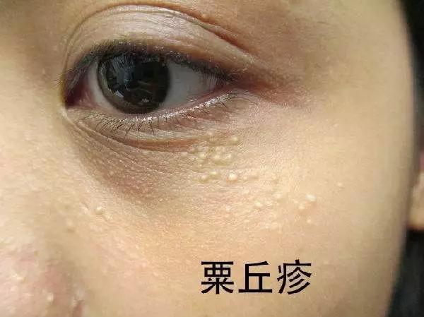 消除眼周脂肪粒最好方法,眼周有脂肪粒用什么眼霜