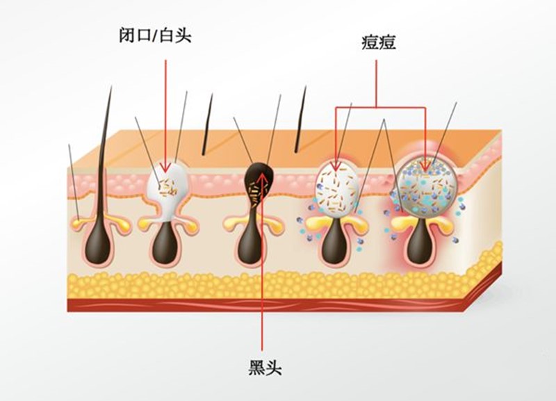 闭口挤了一直长怎么办,闭口到底要不要挤出来