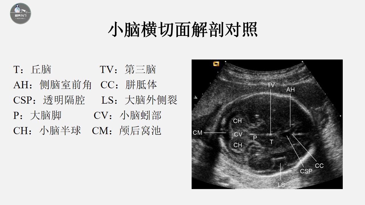 胎儿颅脑超声标准切面图解,胎儿颅脑异常的超声诊断ppt