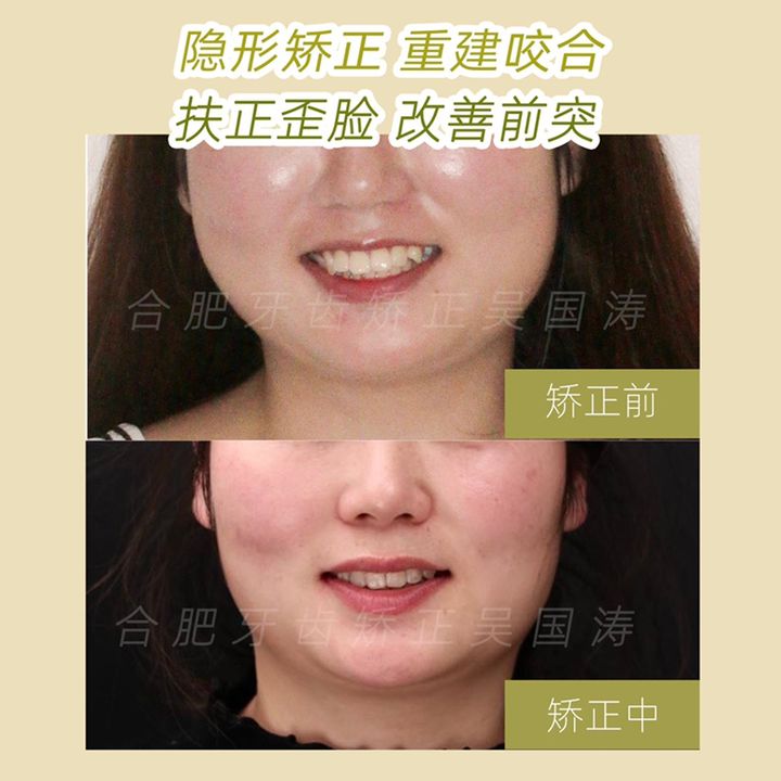 牙齿正畸下颌磨牙,牙列拥挤伴牙齿前突矫正案例