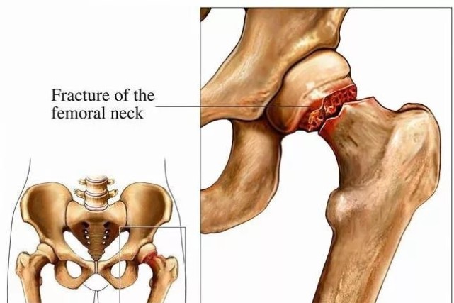 医生讲述90岁老奶奶髋部骨折,髋部骨折危害大老年人摔伤要重视