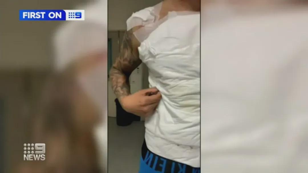 热水袋低温烫伤造成截肢,热水袋烫伤植皮疼吗