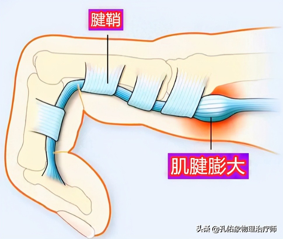 中年妇女手指疼痛僵硬是什么原因,老人手指腱鞘炎如何治疗