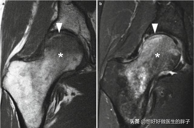 髋关节疼痛两腿不一样长如何康复,左大腿髋关节突然疼痛是什么原因