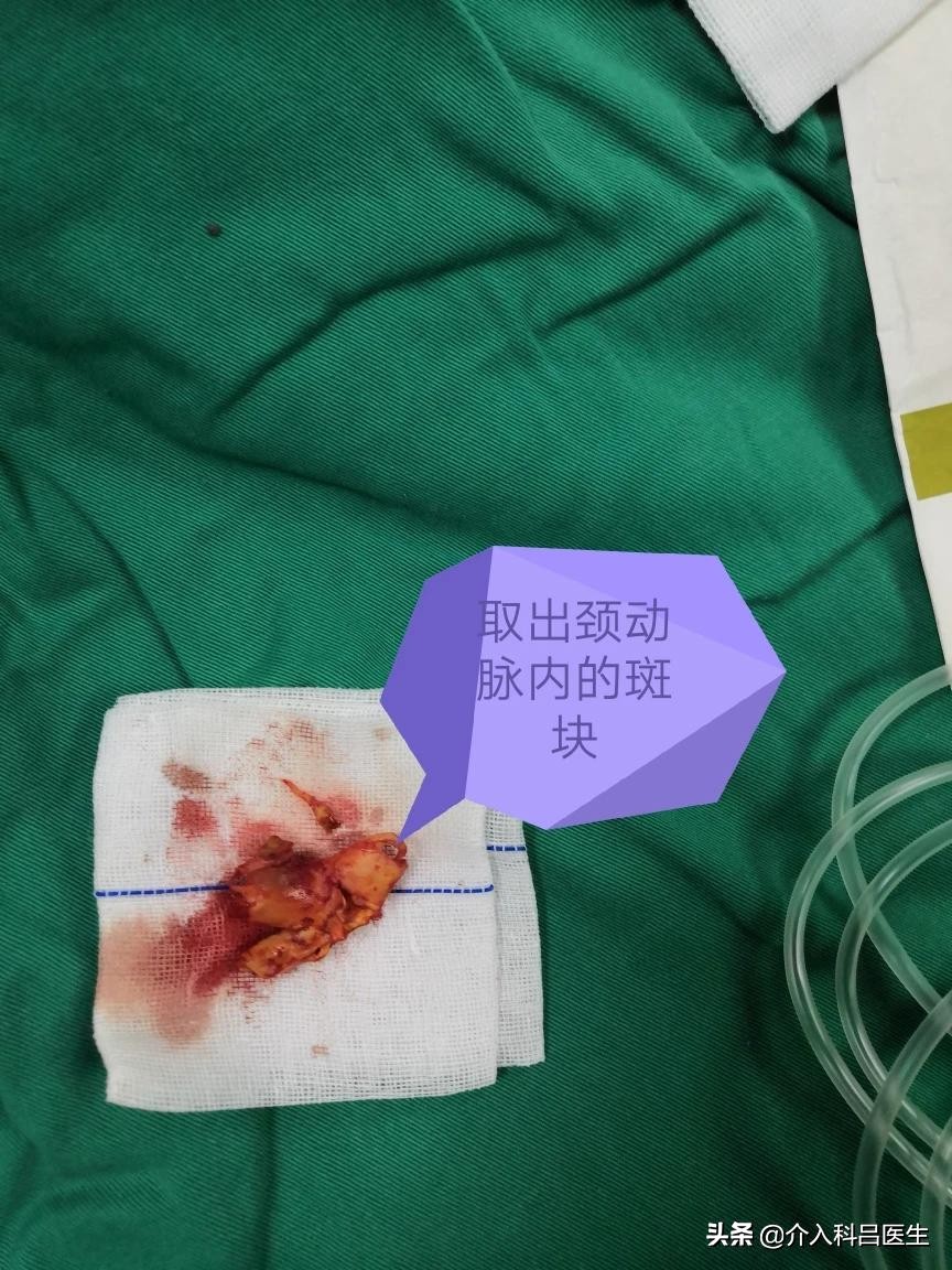 86岁左侧颈内动脉狭窄怎么办,75岁颈动脉狭窄81%咋样治疗