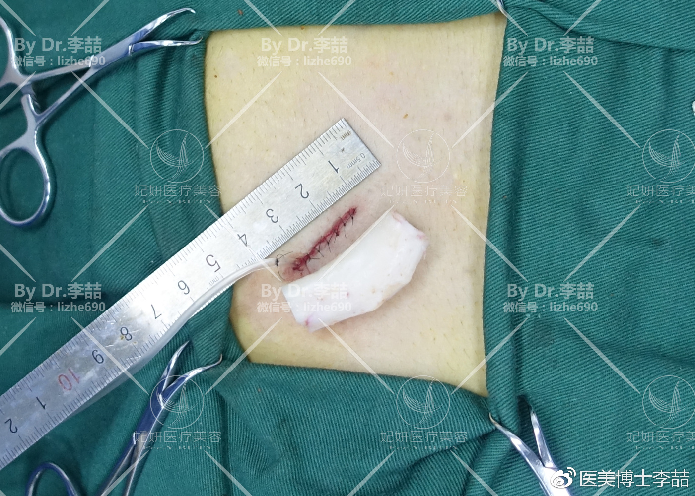 先天性鼻缺损和畸形的修复,先天性鼻中隔缺损