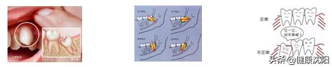 健康科普堂冬季,阻生齿对人体有哪些影响