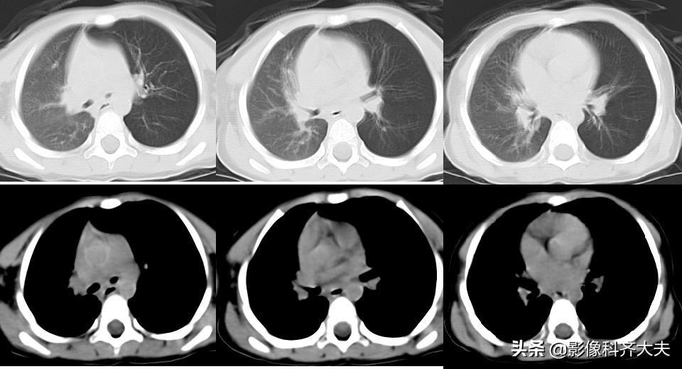 ct能查出气管微小异物嘛,气管异物ct怎么做