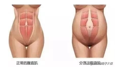 产后腹直肌分离什么症状,产后腹直肌分离如何自测